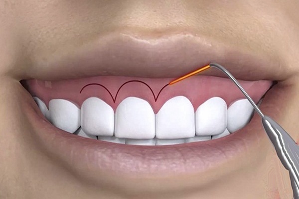 Cười hở nứu - Nha Khoa Trường Sơn