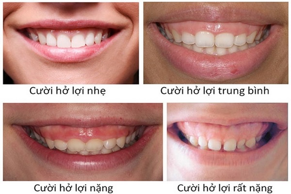 Cười hở nứu - Nha Khoa Trường Sơn