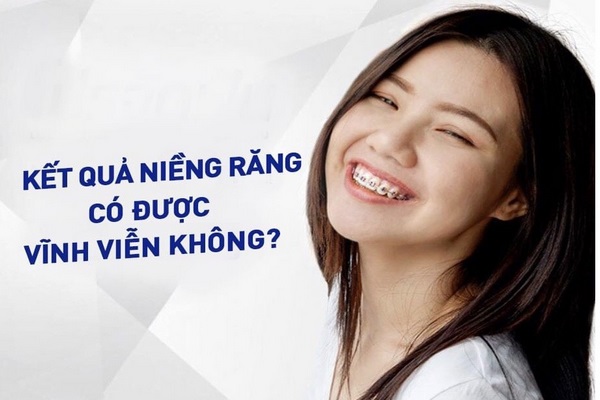 Niềng răng - Nha Khoa Trường Sơn
