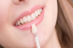 Dán sứ veneer - Nha Khoa Trường Sơn