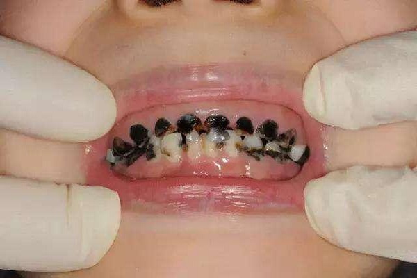 4 thói quen có thể sẽ hủy hoại hàm răng của bé - Nha Khoa Trường Sơn