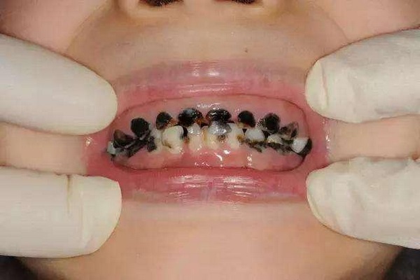 Trẻ có 4 thói quen này bố mẹ cần thay đổi ngay, nó sẽ hủy hoại hàm răng của bé - Ảnh 1. Trẻ có 4 thói quen này bố mẹ cần thay đổi ngay, nó sẽ hủy hoại hàm răng của bé - Ảnh 1.