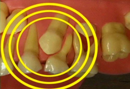 Làm Sao Phân Biệt Được Răng Sữa Và Răng Vĩnh Viễn -6