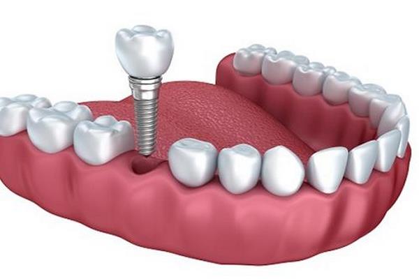 Trồng rrăng implant - Nha Khoa Trường Sơn