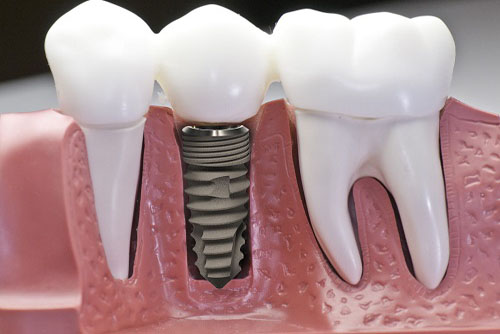 (Kỹ thuật trồng răng Implant)