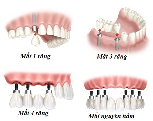 (Trồng răng Implant khôi phục lại cho tất cả các trường hợp mất răng khác nhau)