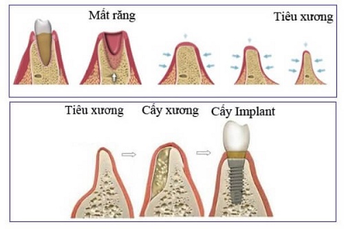 (Trồng răng Implant giúp giữ vững mô xương hàm)